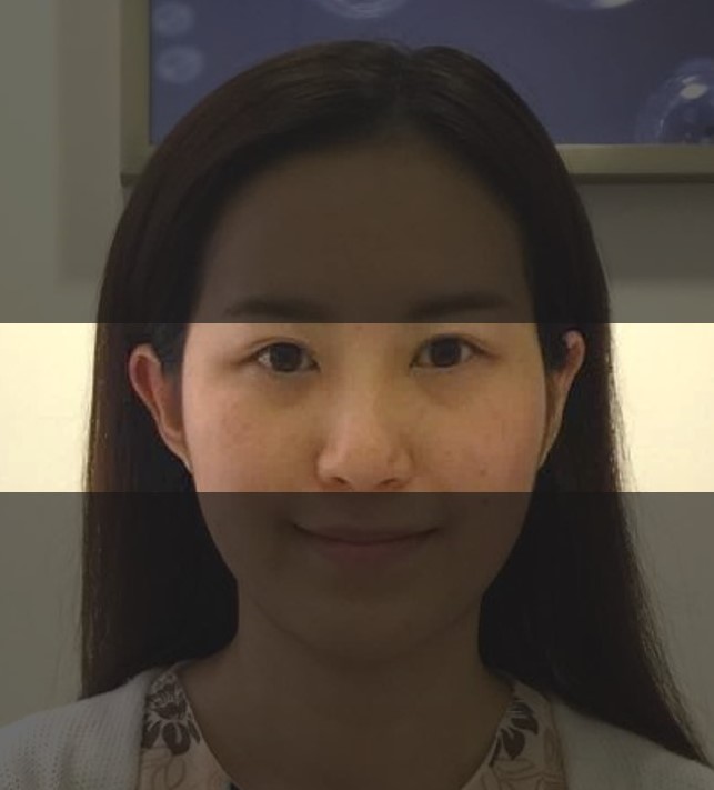 隆鼻 啪骨隆鼻 改善歪鼻 鼻頭大 Ione Theory 一正尚本堂