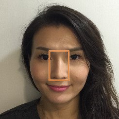 改善鼻骨歪，變得堅挺豐滿（後）