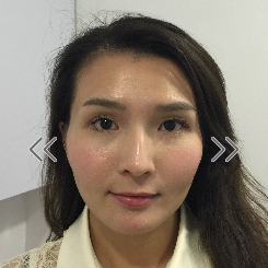 顴骨調整向內收，五官更集中（前）