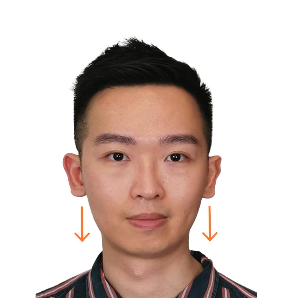 改善歪嘴歪面 (後)