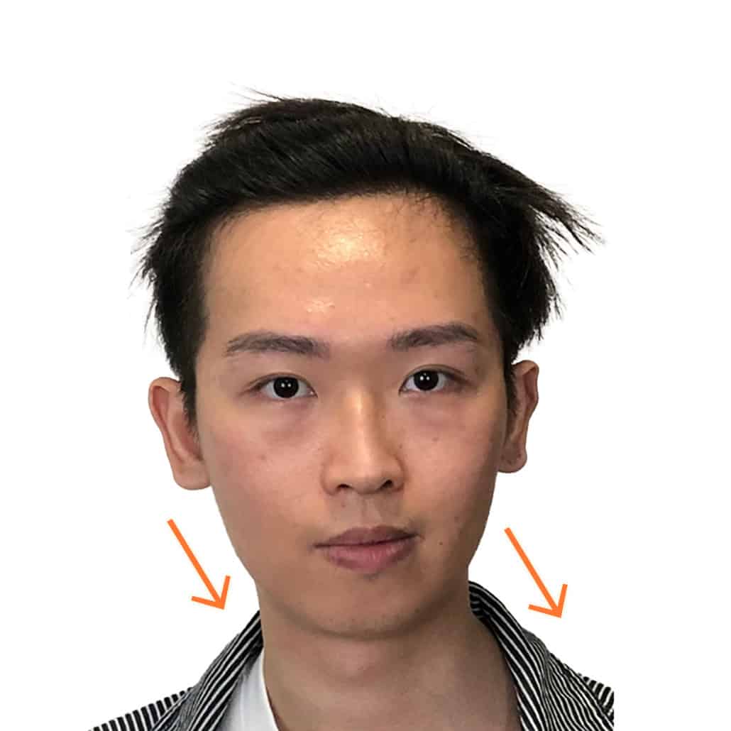 改善歪嘴歪面 (前)