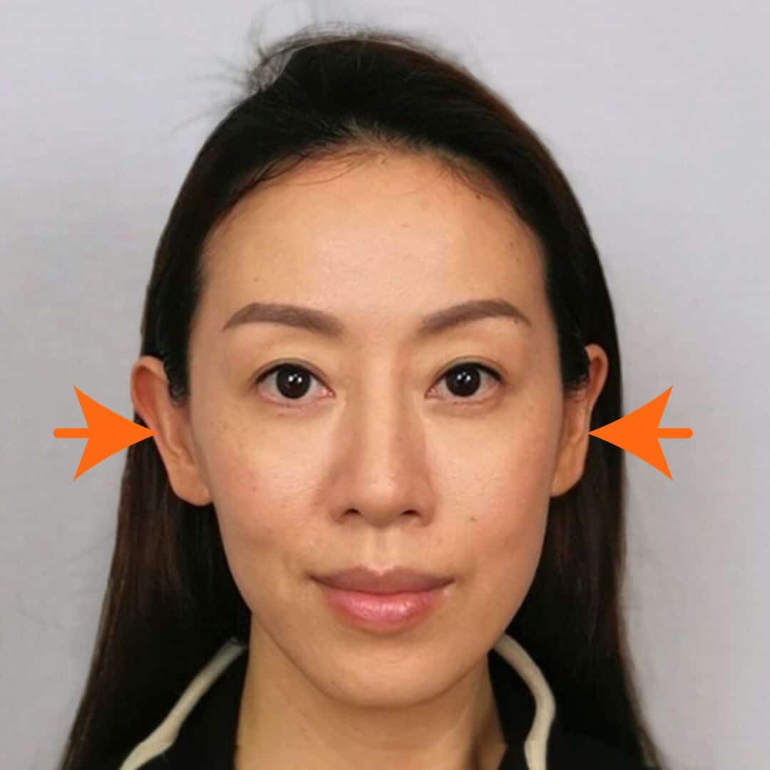 大細面、歪鼻矯正（後）