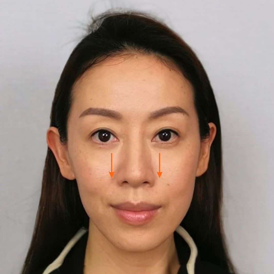 大細面、歪鼻矯正（後）