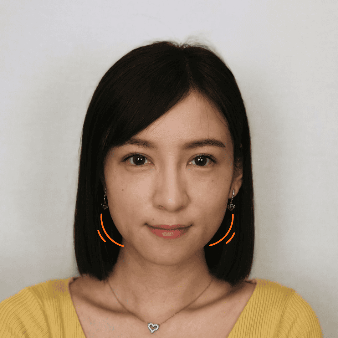 改善三庭比例 腮骨內收 面形線條更順滑 締造柔和感V面小顏 (前)