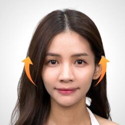 徒手微雕療程後