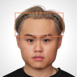 徒手微雕療程後