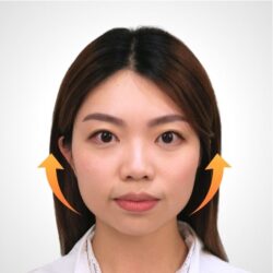 徒手微雕療程後