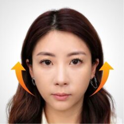徒手微雕療程後