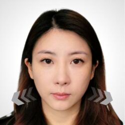 徒手微雕療程前