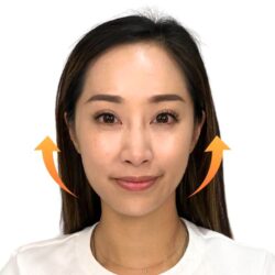 徒手微雕療程後