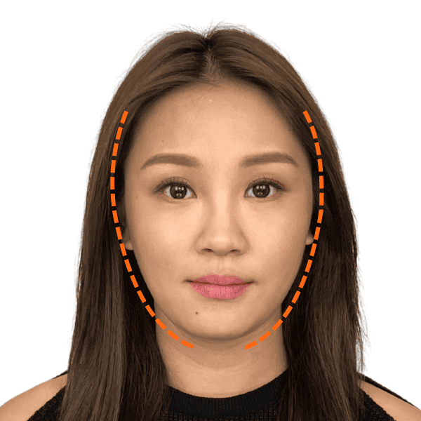 徒手微雕療程後