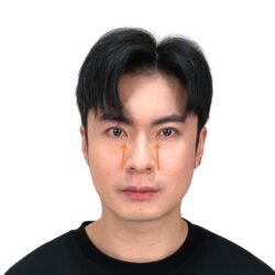 徒手微雕療程後