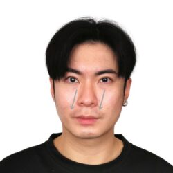 徒手微雕療程前