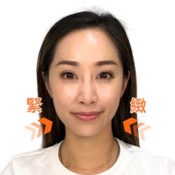 徒手微雕療程後