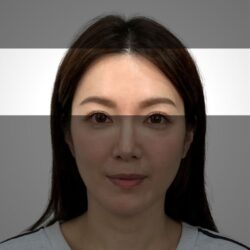徒手微雕療程前
