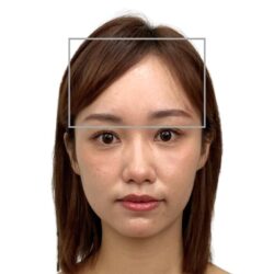徒手微雕療程前