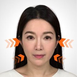 徒手微雕療程後