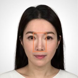 徒手微雕療程後