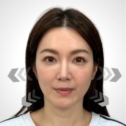 徒手微雕療程前