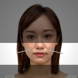 徒手微雕療程前