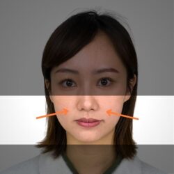 徒手微雕療程後